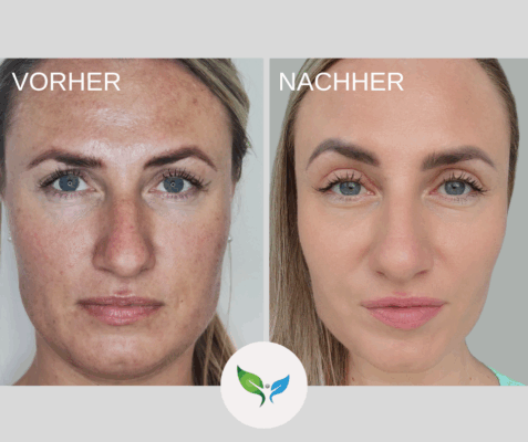 Blepharoplastik - Oberlidstraffung Vorher Nachher - ganzer Gesicht