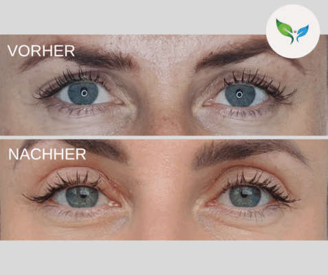 Blepharoplastik - Oberlidstraffung Vorher Nachher Bilder