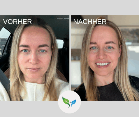 Blepharoplastik - Oberlidstraffung Vorher Nachher - junge Frau – ganzes Gesicht