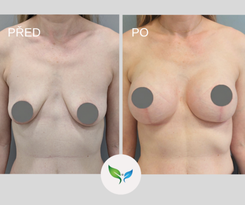Augmentace s modelací