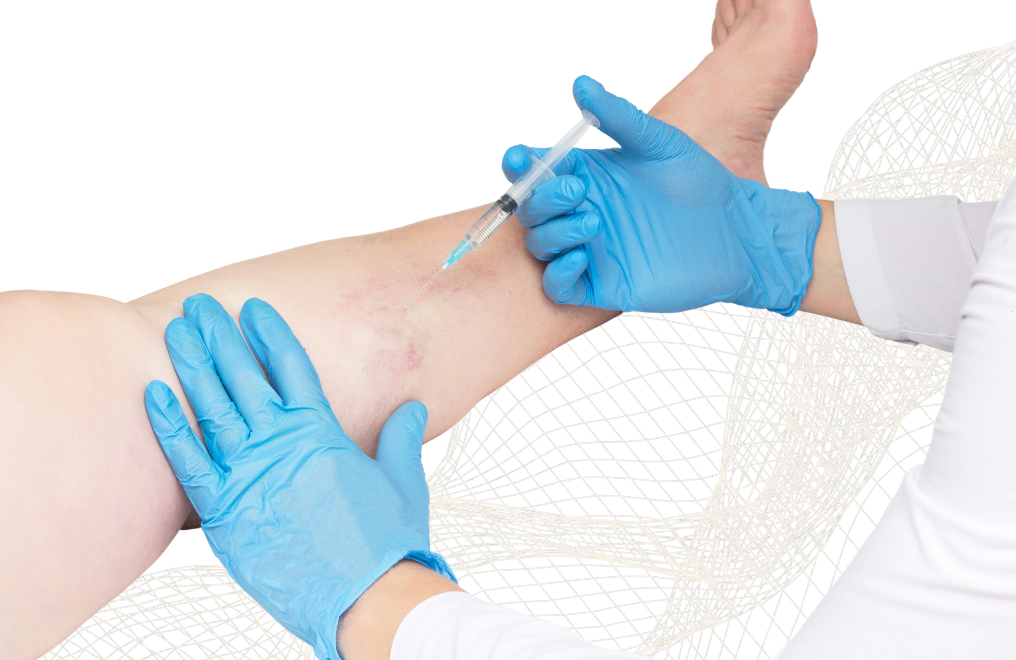 Injekční sklerotizace křečových žil