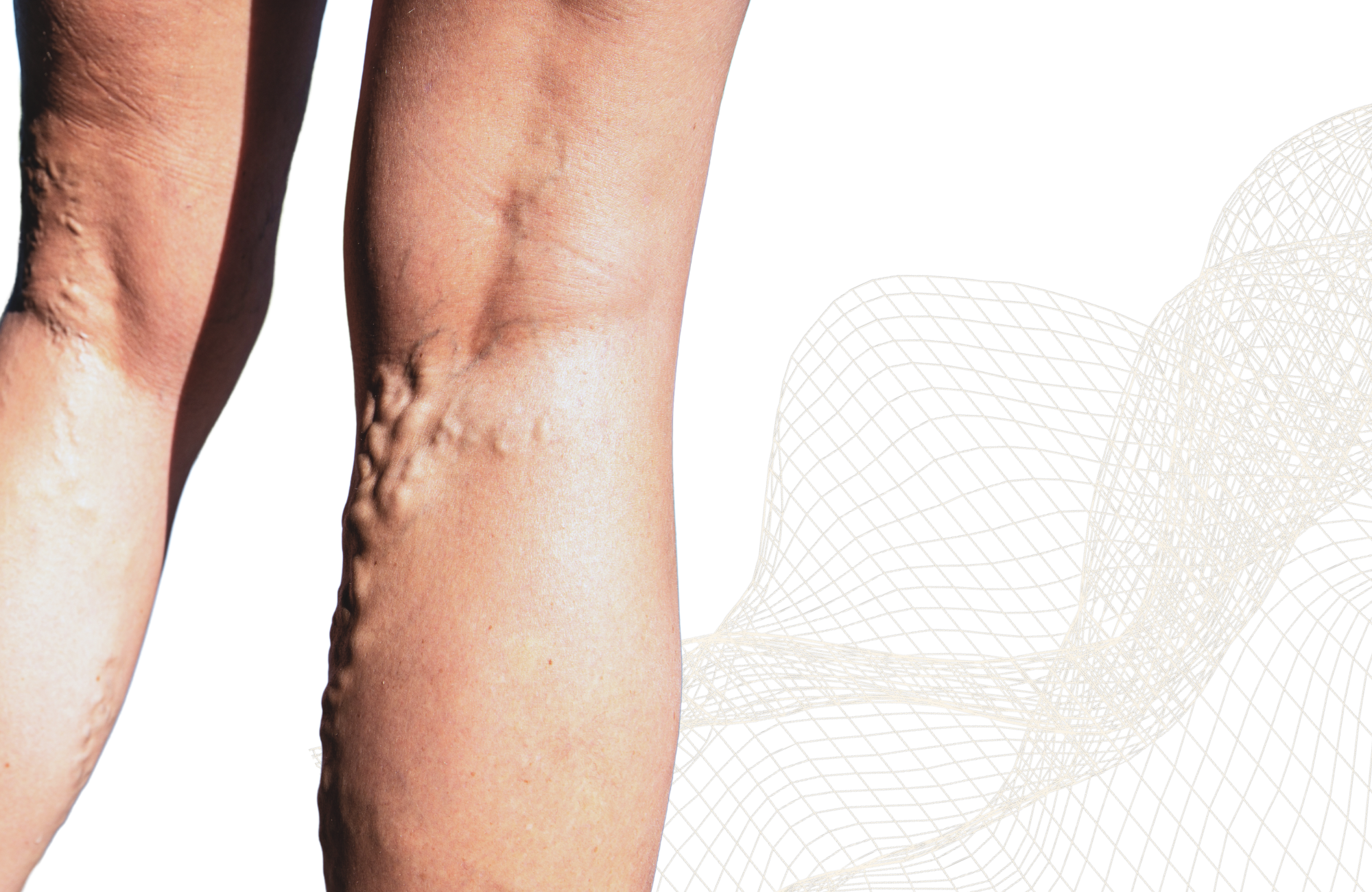 Operace křečových žil