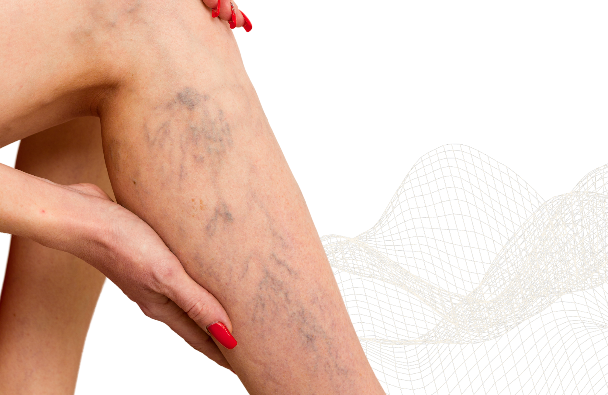 Laserové operace žil v lokální anestezii