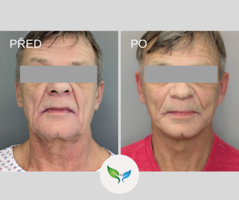 SMAS facelift - před a po