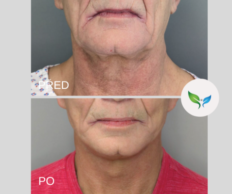 SMAS facelift proměna
