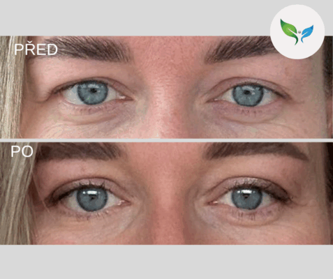 Operace horních víček proměna