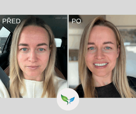 Blefaroplastika horních víček - celý obličej