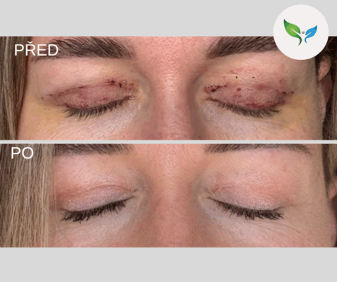 Blefaroplastika - hojení a jizvy před a po