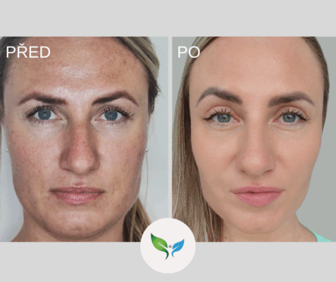 Víčka - plastická operace horních víček - celý obličej