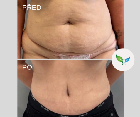 Abdominoplastika