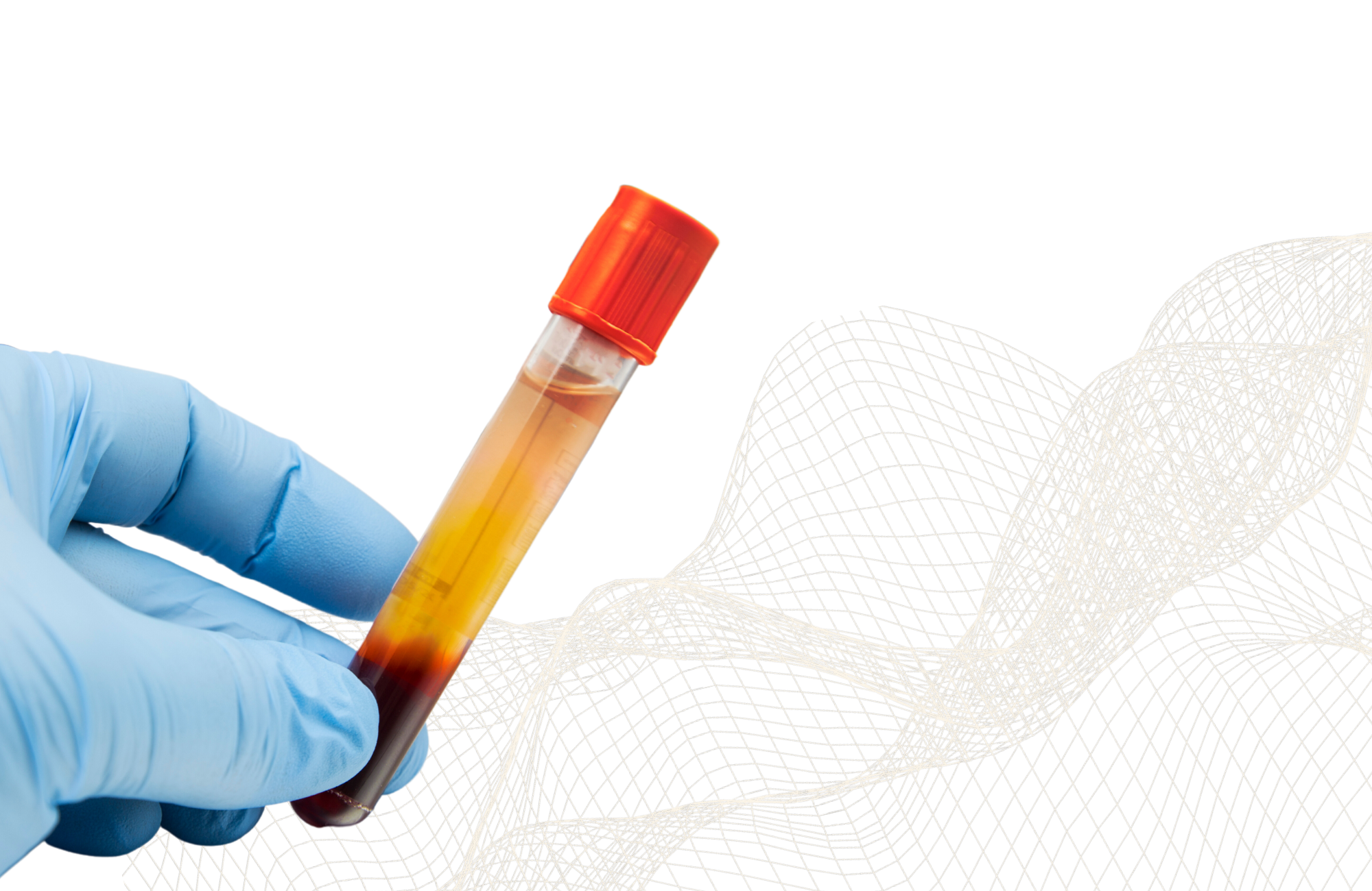 Léčba krevní plazmou - kloubů, vazů a šlach