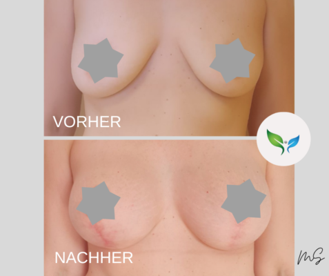 Bruststraffung vorher und nachher – natürliches Ergebnis
