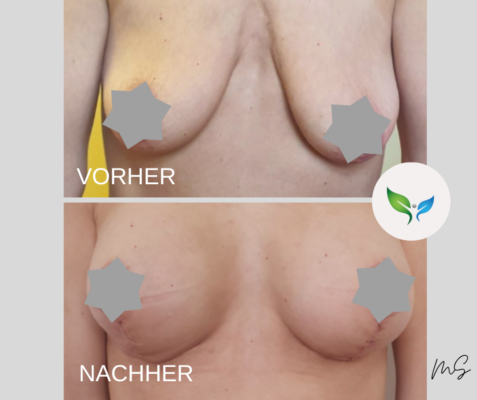 Bruststraffung vorher und nachher – straffere Silhouette
