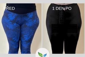 Liposukce vnějších stehen před a po