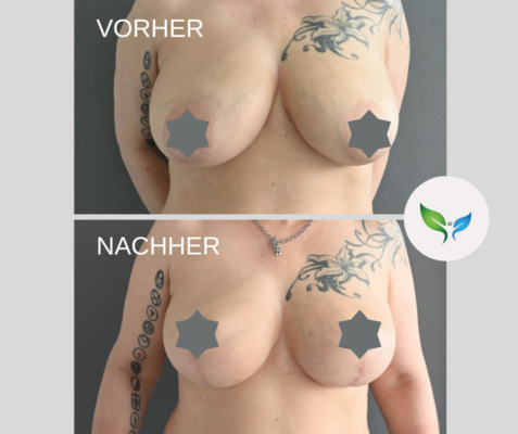 Bruststraffung Ergebnis – Vorher-Nachher Fotos