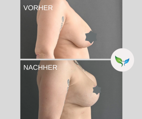 Vorher-Nachher Vergleich nach Bruststraffung