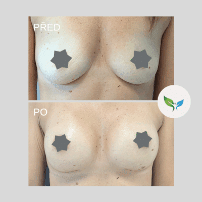 Augmentace prsou