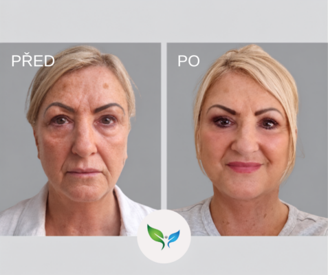 Deep plane Facelift