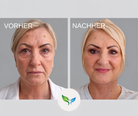 Deep plane facelift