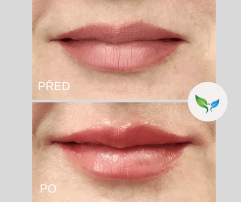 Výplň rtů