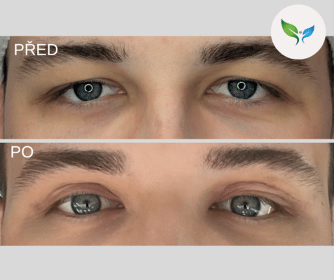 Blepharoplastika pred a po 2