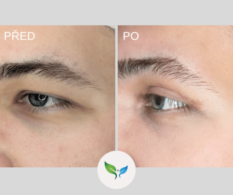 Blepharoplastika pred a po