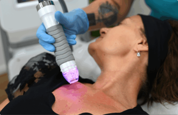 Mikrojehličková radiofrekvence Vivace - omlazení dekoltu