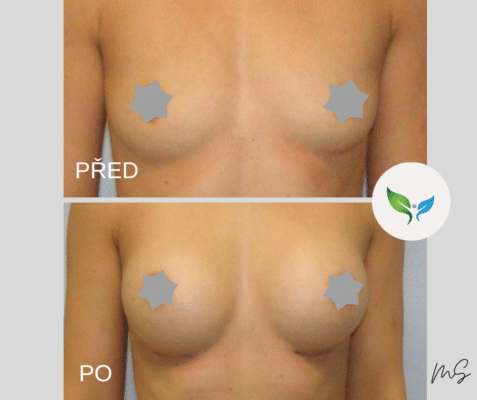 Augmentace prsou silikonovými implantáty před a po