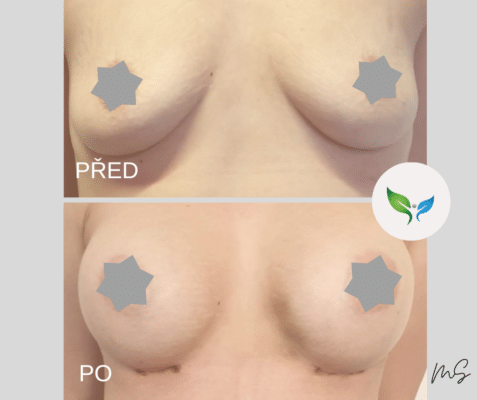 Zvětšení prsou silikonovými implantáty před a po