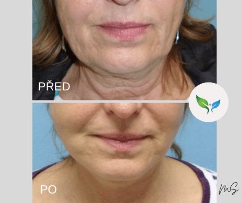 SMAS Facelift a necklift před a po