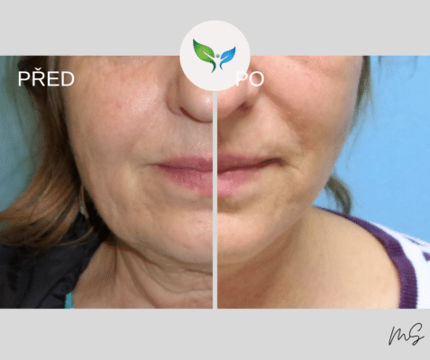 Facelift a necklift v celkové anestezii pro výrazné omlazení obličeje