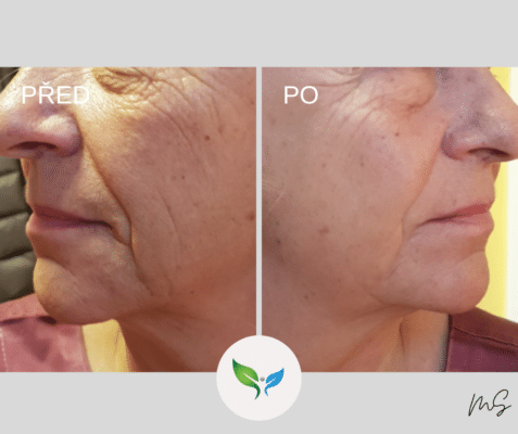 SMAS Facelifting a necklift před a po