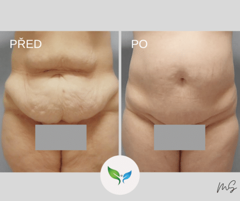 Abdominoplastika - plastická operace břicha před a po