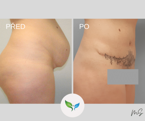 Plastika břicha - Abdominoplastika před a po