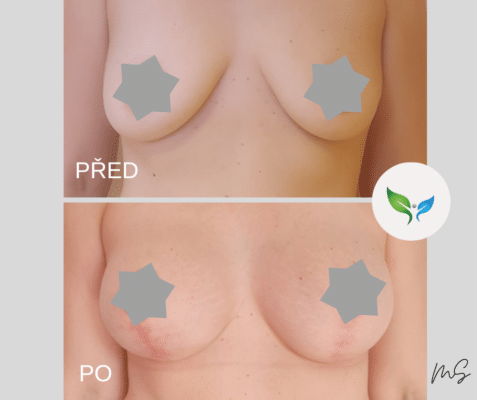 Modelace prsou - mammaplastika proměna