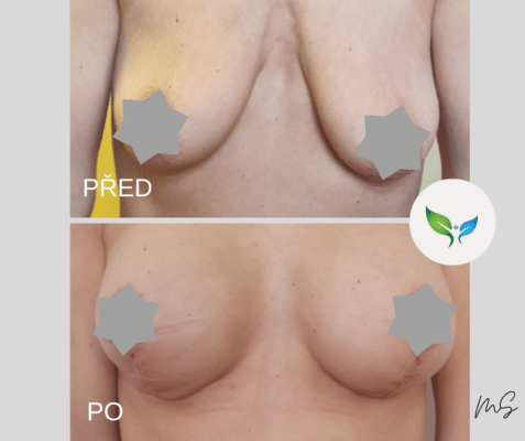 Modelace prsou - mammaplastika před a po
