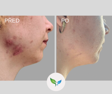 Frakční laser - jizvy po akné před a po