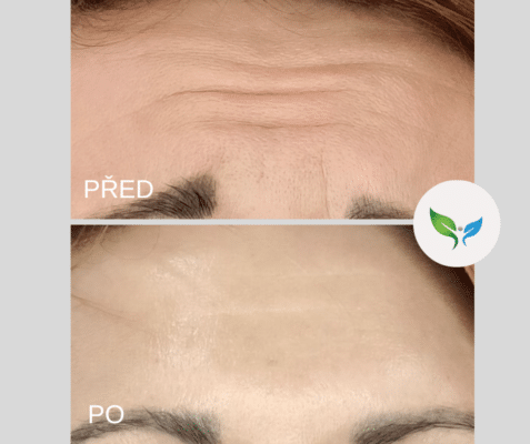 odstranění vrásek čelo před a po
