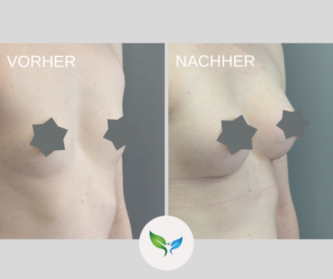 Brustvergrosserung Vorher und Nachher Bilder 18 Vorher-Nachher Vergleich – Brustvergrößerung mit sanftem Effekt