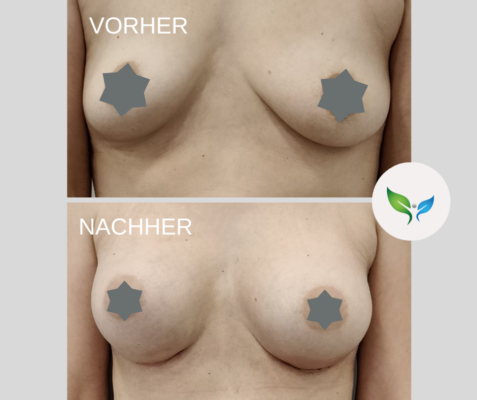 Brustvergrosserung Vorher und Nachher Bilder 20 Brustvergrößerung Ergebnis – dezente Vorher-Nachher Aufnahme