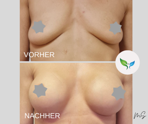 Brustvergrößerung vorher und nachher – deutlicher Unterschied