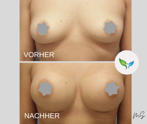 Brustvergrosserung Vorher und Nachher Bilder 6 Brustvergrößerung vorher und nachher – ästhetisch und natürlich