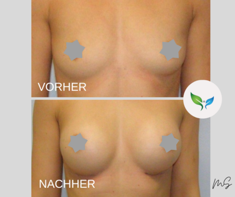 Vorher-Nachher Vergleich nach Brustaugmentation