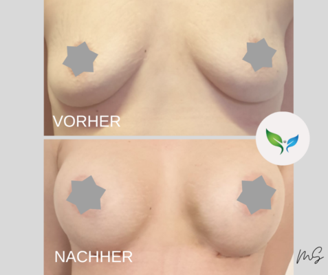 Vorher-Nachher – Brustaugmentation mit natürlichem Effekt