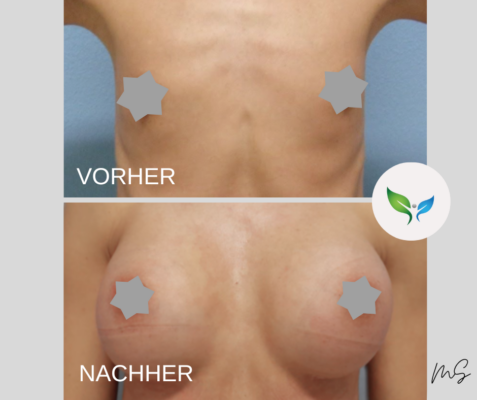 Brustvergrößerung - Brust-augmentation vorher und nachher – deutliche Formverbesserung
