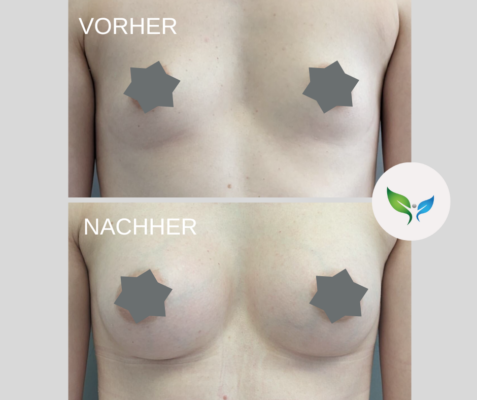 Natürliche Brustvergrößerung – Vorher-Nachher Beispiel