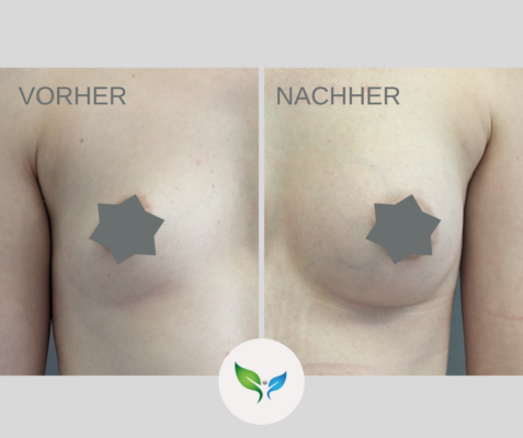 Brustvergrosserung Vorher und Nachher Bilder 16 Brustaugmentation vorher und nachher – harmonisches Ergebnis