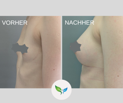 Brustvergrosserung Vorher und Nachher Bilder 22 Brustaugmentation vorher und nachher – sanfte Veränderung
