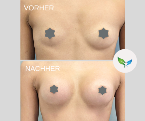 Brustvergrosserung Vorher und Nachher Bilder 2 Brustvergrößerung vorher und nachher – natürliches Ergebnis