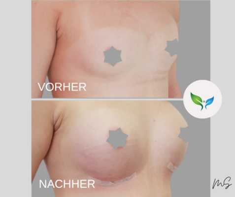 Brustvergrosserung Vorher und Nachher Bilder 26 Brustvergrößerung mit silikon Implantate - vorher und nachher – ästhetisch und natürlich